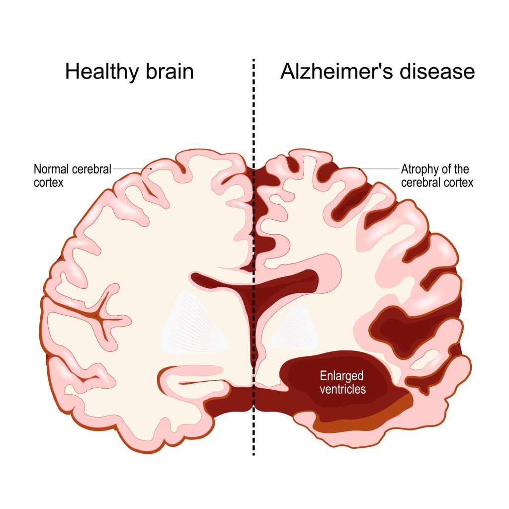 Alzheimer inflammation